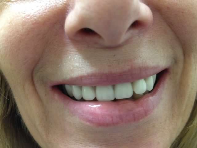 Upland Spa Dentistry - Before After